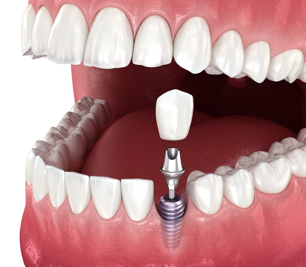 implant dentar București