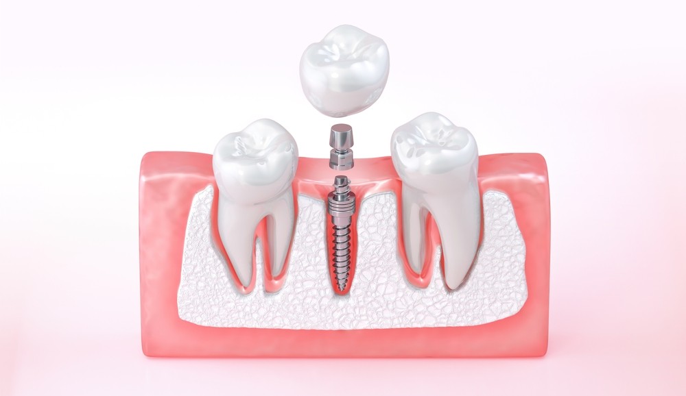 implant dentar București
