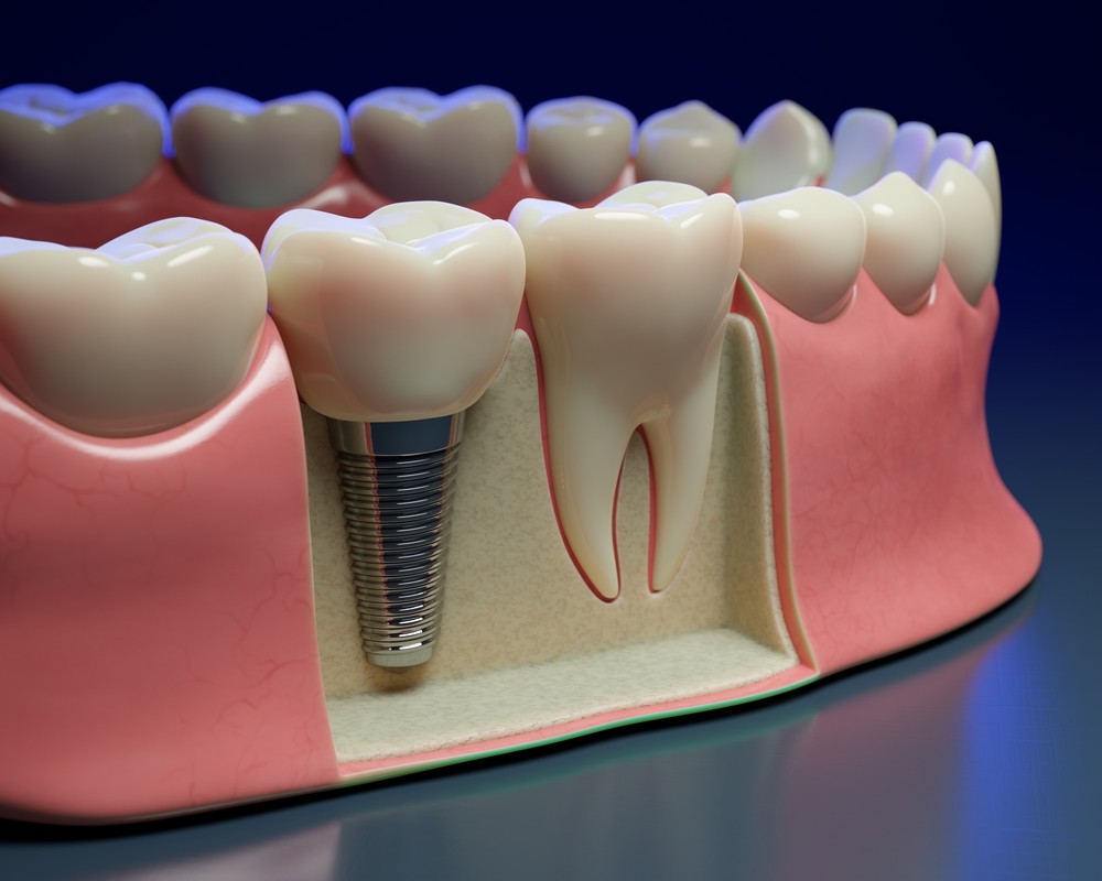 implant dentar București