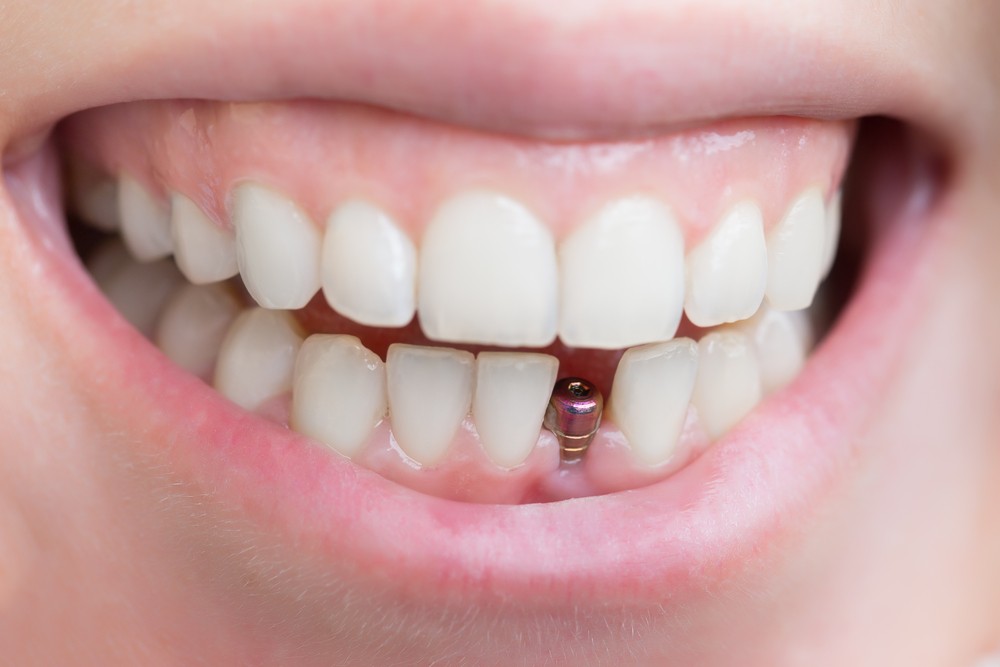 implant dentar București