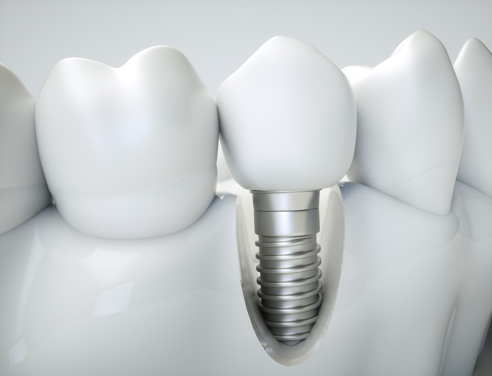 implant dentar bucuresti, implantologie bucuresti, clinica stomatologica art implant bucuresti